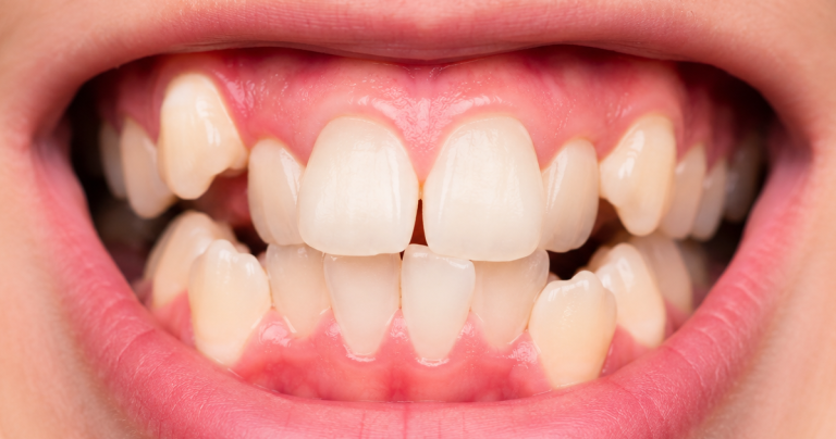 denti storti