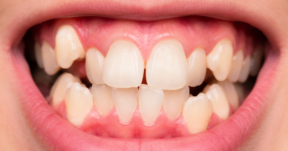 denti storti